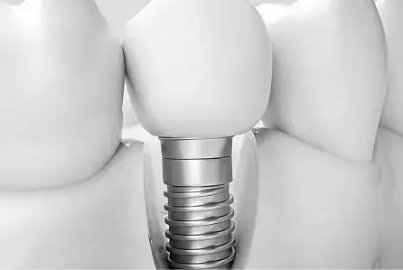 Implant Dentistry