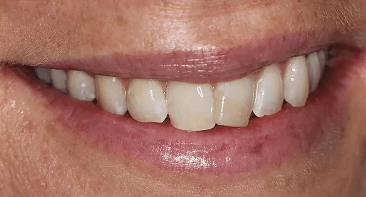 Crowns and Porcelain Veneers