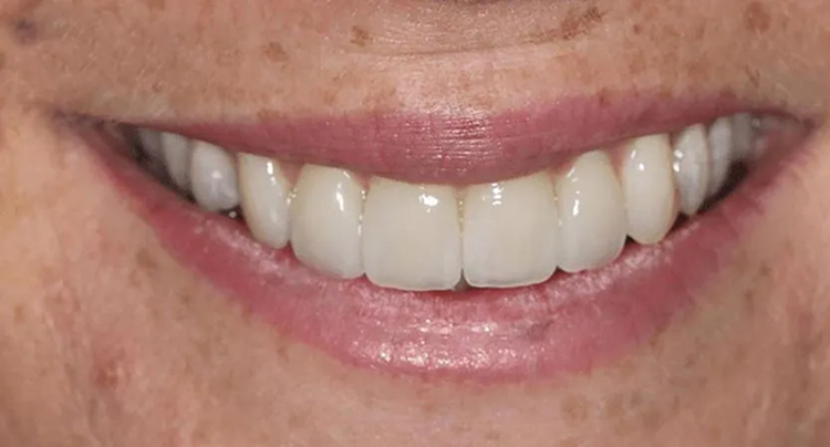 Crowns and Porcelain Veneers