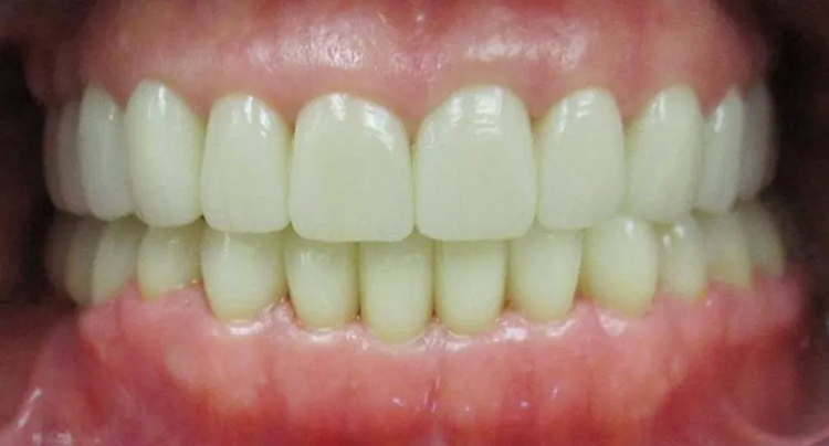 Crowns and Porcelain Veneers