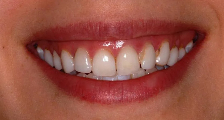 Porcelain Veneers