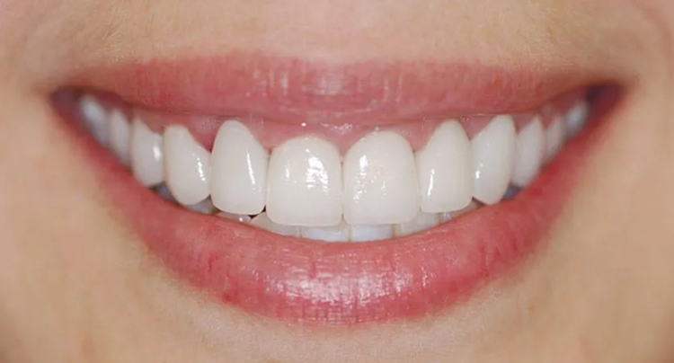 Porcelain Veneers