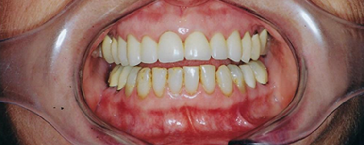 Veneers and Crowns