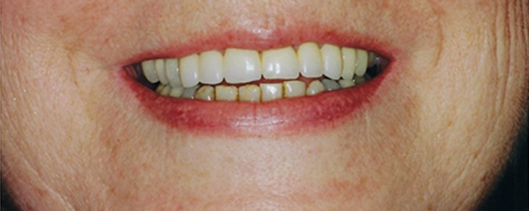 Veneers and Crowns