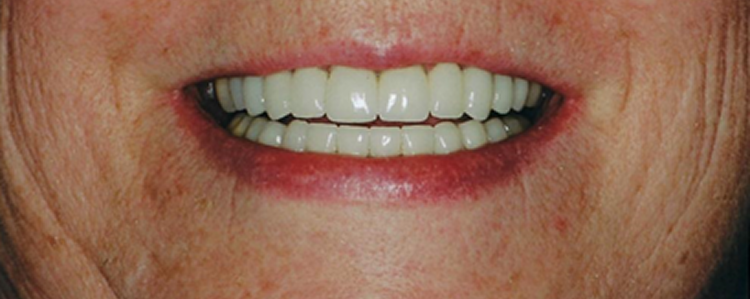 Veneers and Crowns