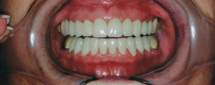 Veneers and Crowns