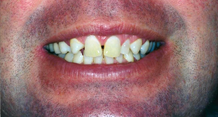 Veneers and Crowns