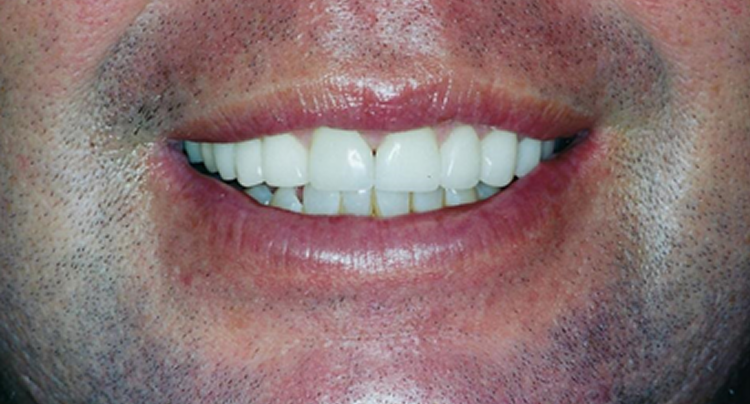 Veneers and Crowns